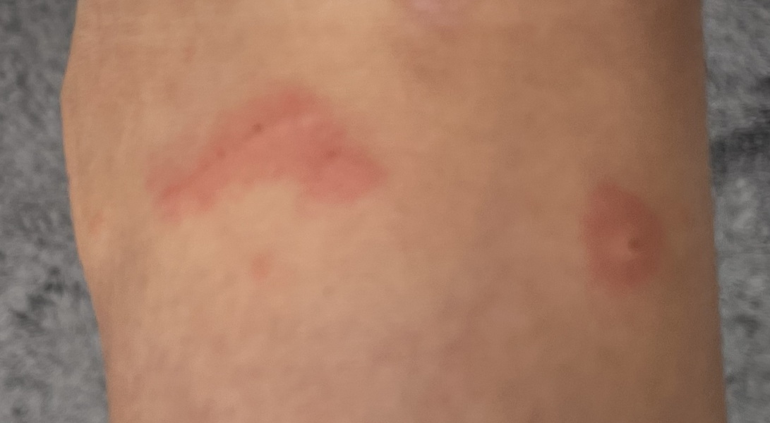 Any idea what these bites are from?