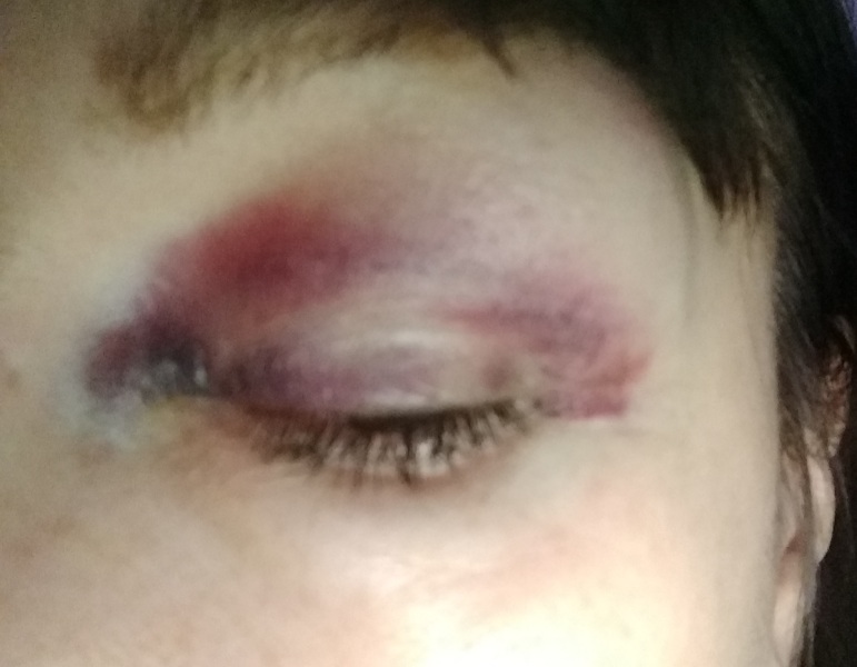 To think this black eye was not an accident? Warning pic of black eye