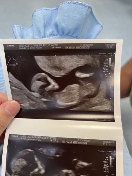 Boy or girl- Nub theory!