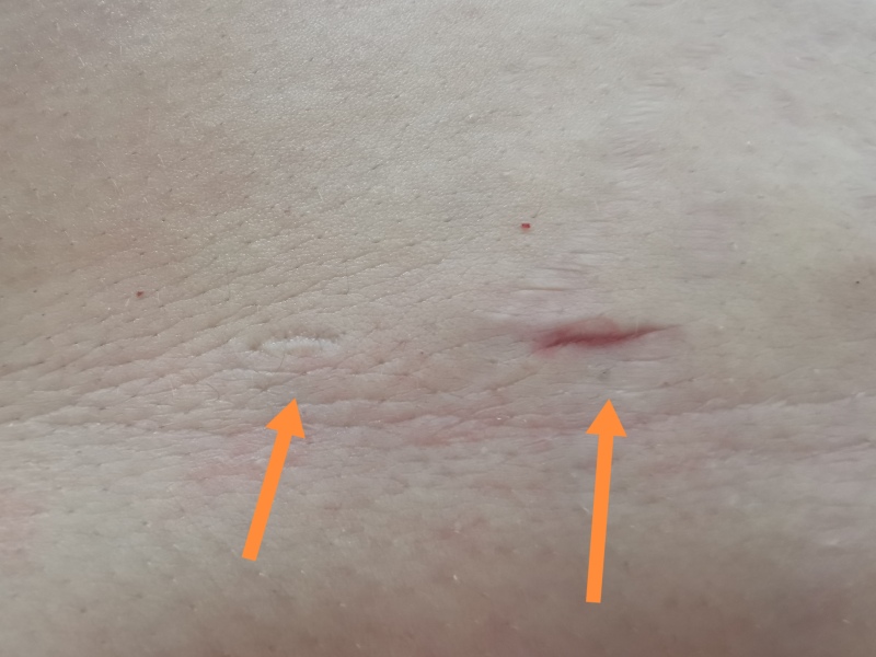 Anyone had a laparoscopy?