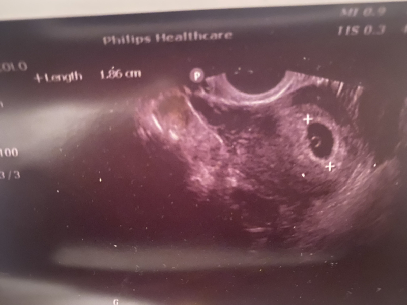 Lmp 8w4d, scan shows 5w3d (now 6w1d)