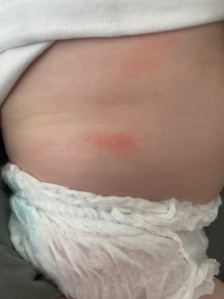 Small Red Bumps