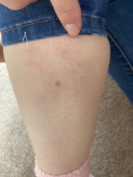 Recalled after a mole scan.