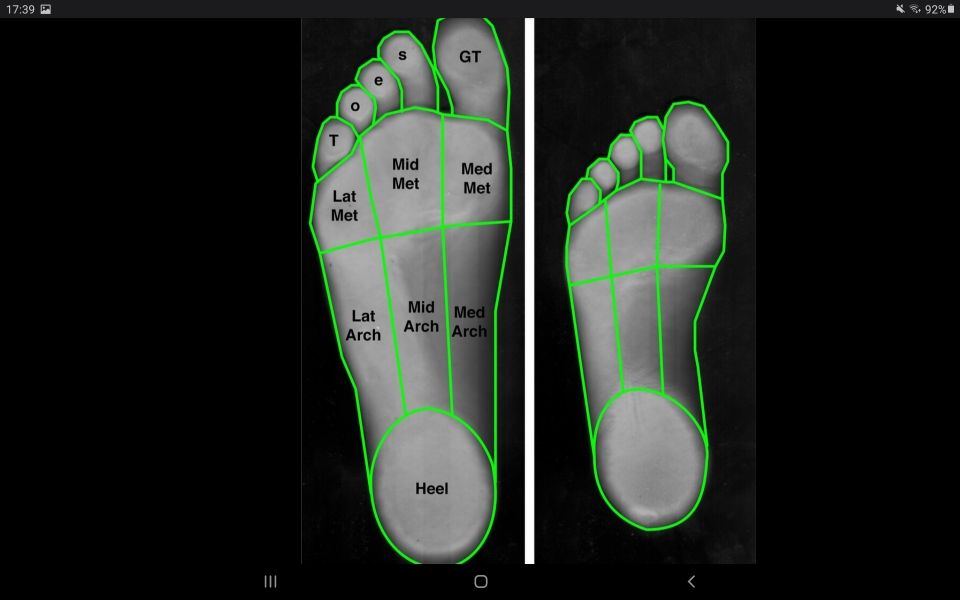 Cracked heels/hole in foot (gross foot photo included)