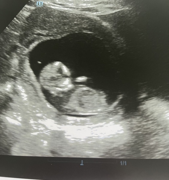 Boy or girl? Nub theorh