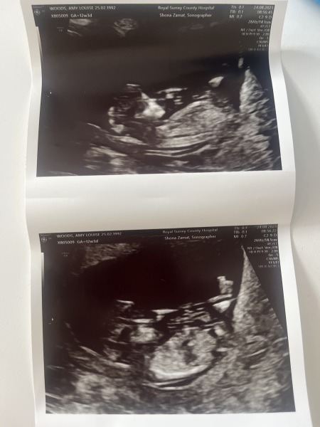 12 week scan - nub theory