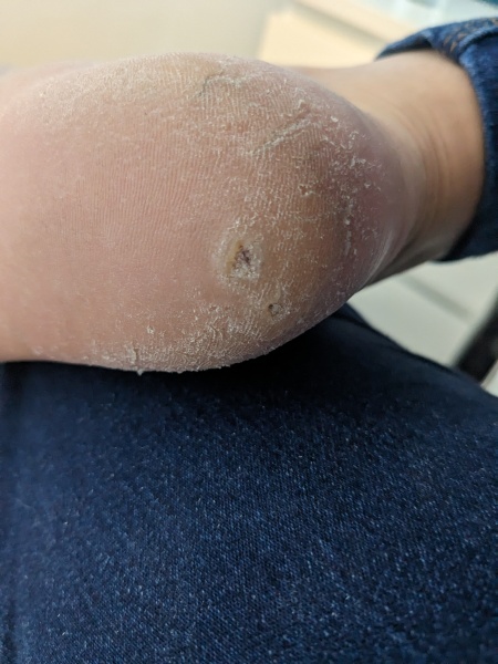 Cracked heels/hole in foot (gross foot photo included)