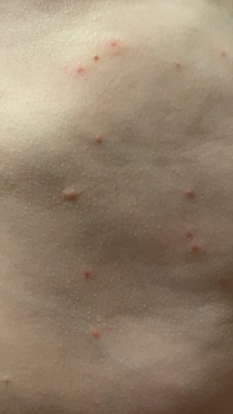 Is this chicken pox?