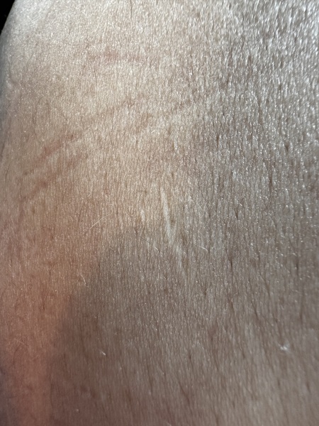 Anyone had a laparoscopy?