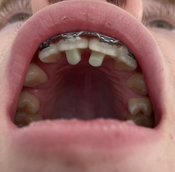 Any orthodontists about? Need advice about DS brace