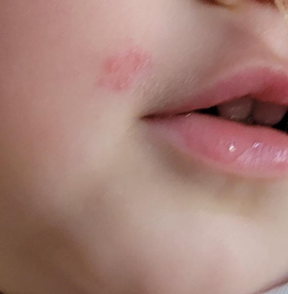 Could this be a cold sore?