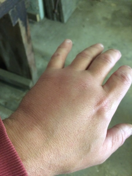 Husband has been stung by a wasp