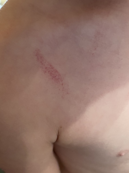 Is this a rash?