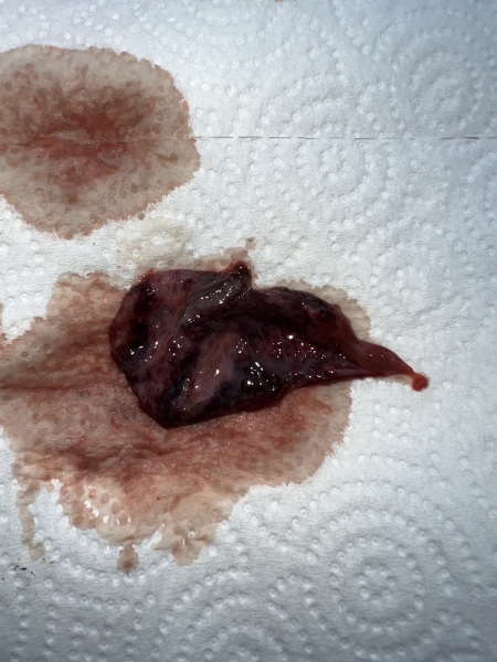 Blood clot, or miscarriage? [content warning: graphic image included]