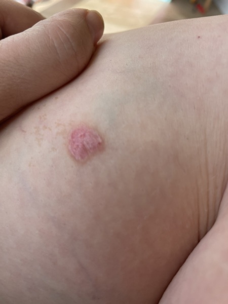 If it's not skin cancer- what is it?