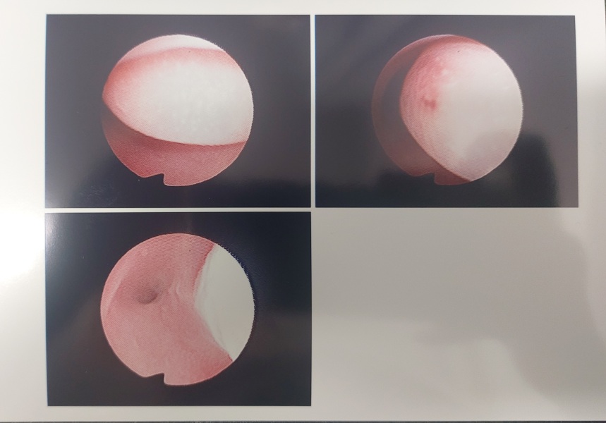 Sudden uterine polyp