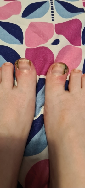 Ingrown toenail