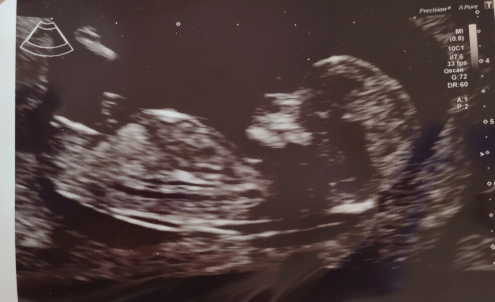 Ultrasound - sex prediction