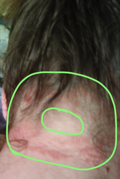 Does anyone know what this rash is?