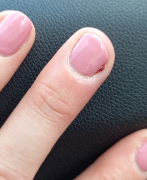 Infected cuticle