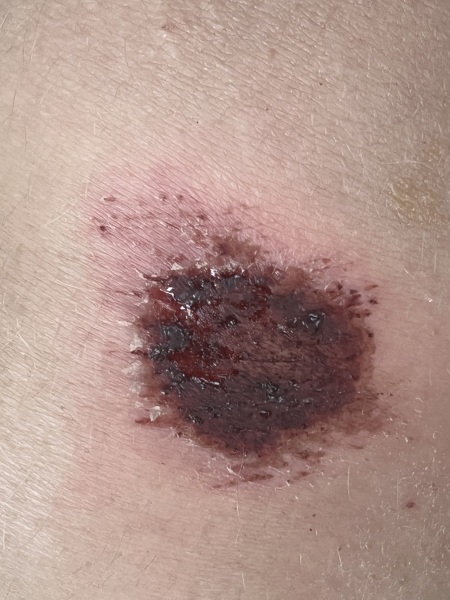 Is this graze infected? (Pic)
