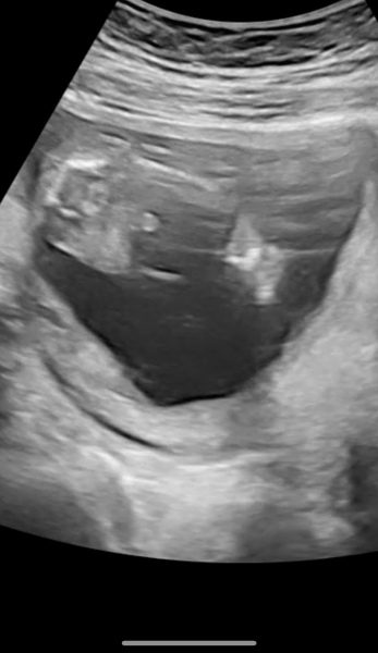 Boy or girl? Potty shot!