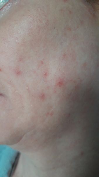 Spots on face