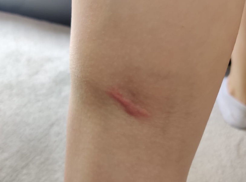 What bit me???