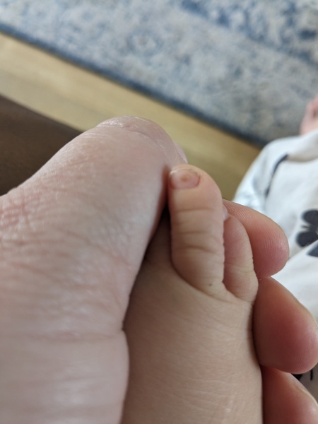 Light brown spot under toddlers toenail. Photo