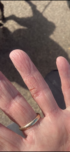 What to use to treat contact dermatitis
