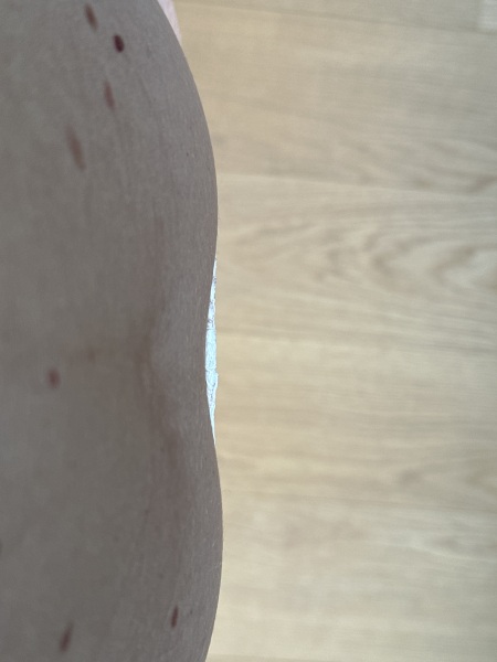 What the heck are these two lumps on my abdomen?