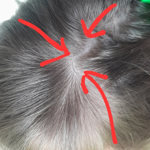 Is this headlice?  Photo attached