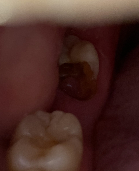 Wisdom tooth out under local/living alone - how to prepare? (Gross photo, sorry)