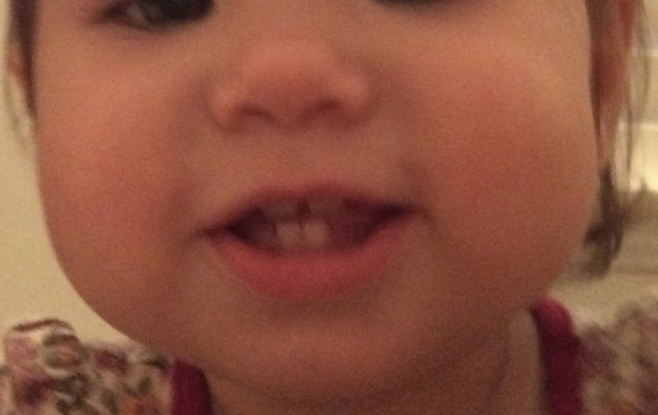 Dimple caused by cheek injury