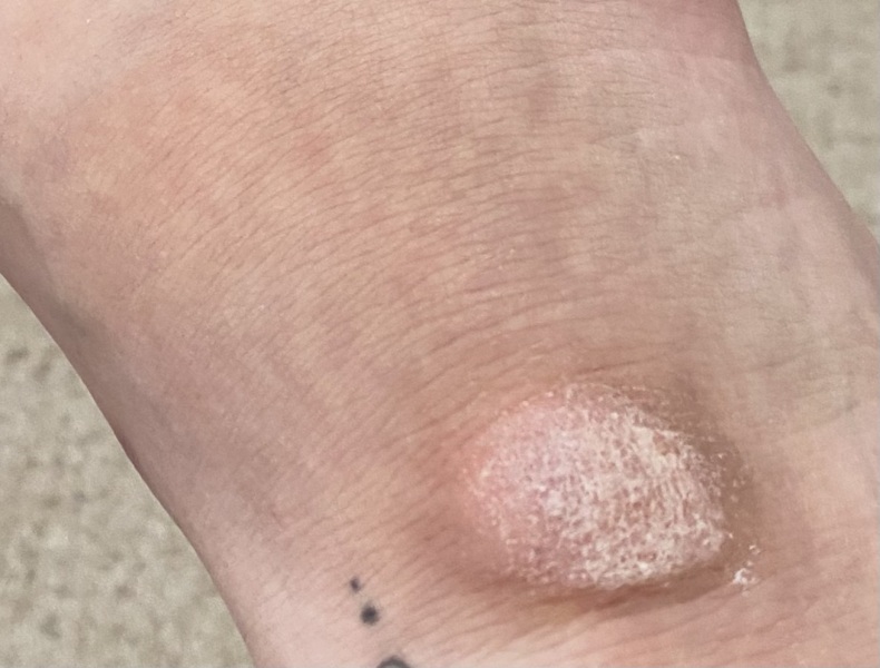 Ganglion cyst or callus? Dry lump on ankle/foot