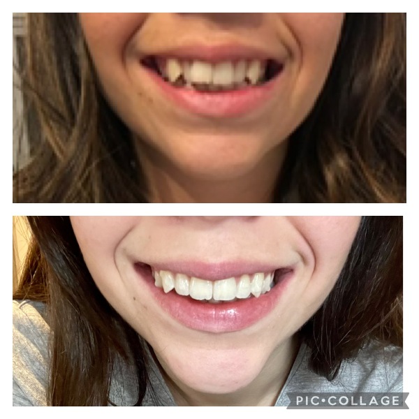 Adult braces