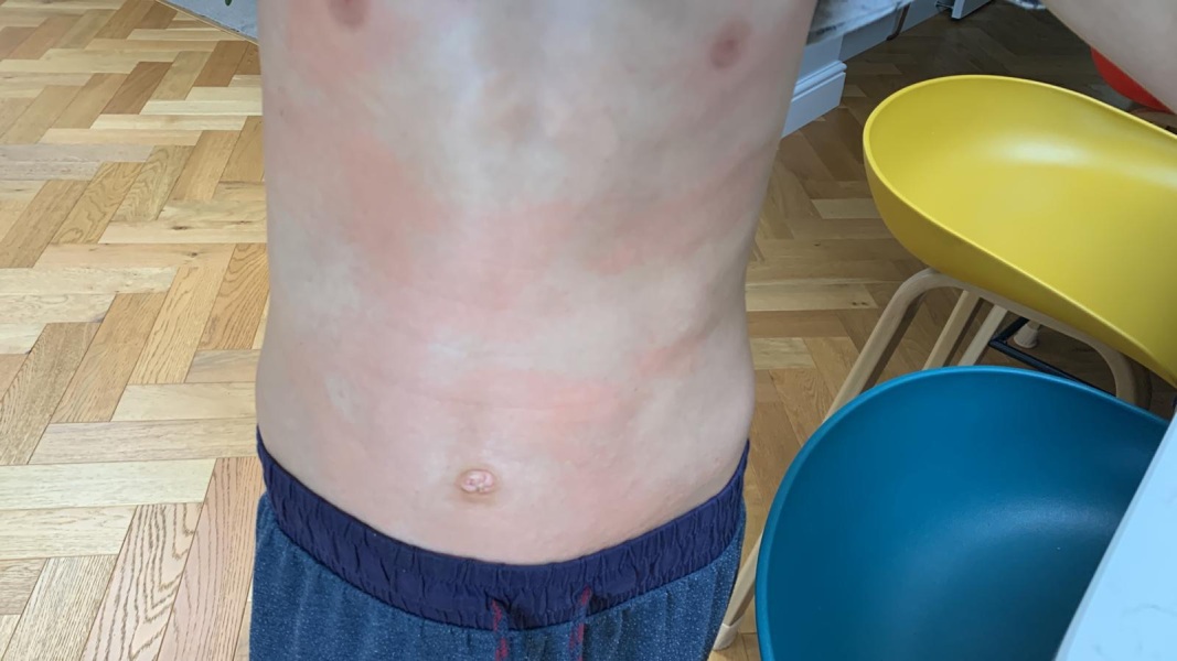 Unexplained rash - allergy test? (Pic)