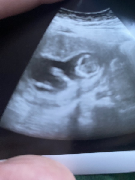 12+3 scan… gender guesses? Just for fun!