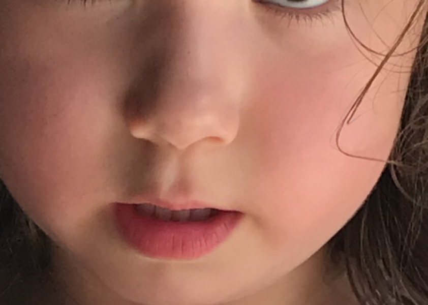 Dimple caused by cheek injury