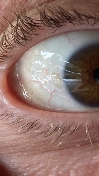 Graphic photo of wrinkly eyewhite...do I need to see a doc?
