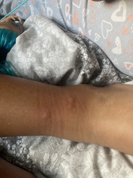 What are these lumps?