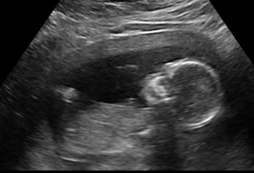 Nub theory at 15 weeks?