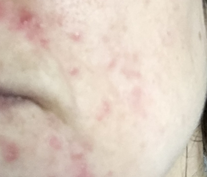 Spots on face
