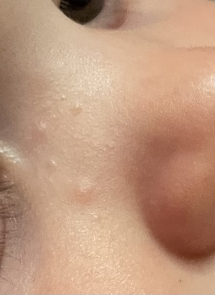 Molluscum contagiosum ? Or just toddler acne
