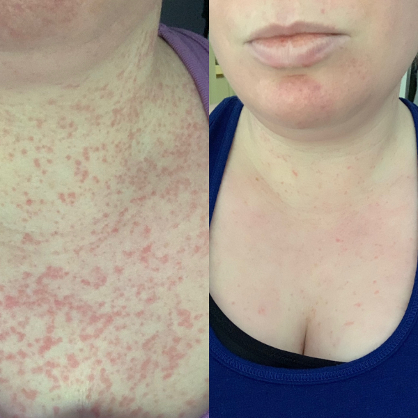 Antihistamine and urticaria help needed