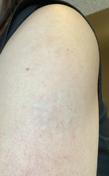 Have you had tattoo 'removal' and how were the results?