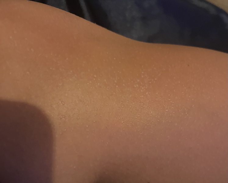 What are this random tiny blisters that have just appeared all