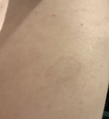 What is this rash on me?! Pics included