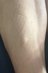 Lumpy Legs