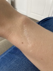 Recalled after a mole scan.